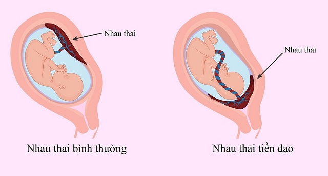 Sự khác biệt giữa nhau thai bình thường và nhau thai tiền đạo
